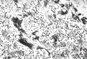 F, 62y. | myxoma atrii F, 62y. | myxoma atrii